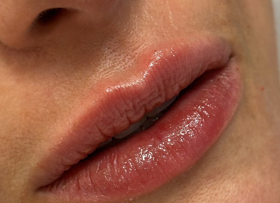 Detalhe de lábios após preenchimento labial realizado na Harmê